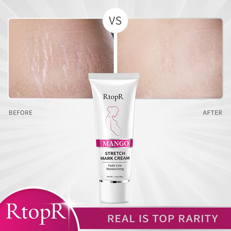 RtopR Mango Stretch Mark Cream for Pregnancy, Stretch Mark Repair Cream, Fade Line, Moisturizing and Non-Greasy, Safe to Use When Pregnant