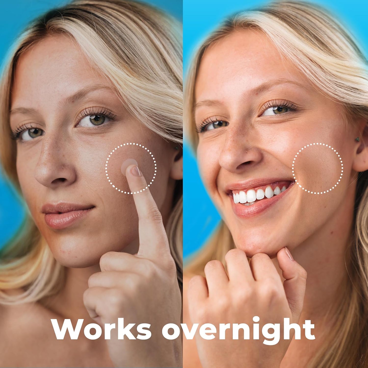 Pimple Patches for Face (500 Patches), Hydrocolloid Acne Patches with Tea Tree Oil, Pimple Patch Pimple Stickers - Hydrocolloid Patch Acne Dots - Acne Pimple Patches For Face - Zit Patches